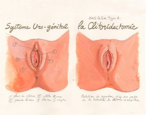 Schémas excision (clitoridectomie) en image