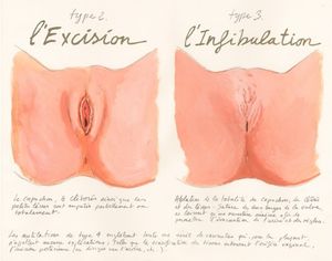 Schémas excision (infibulation) en image